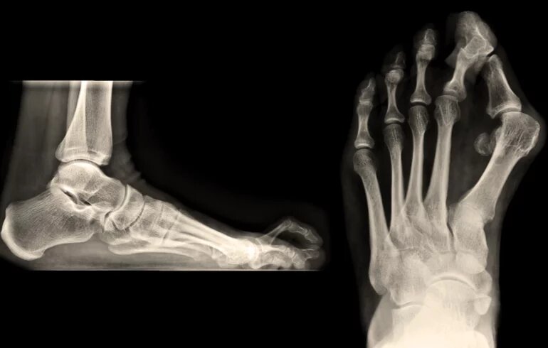 Kalapácsujj, bütyök